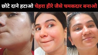 Home Remedies For Tiny Bumps  चेहरे से छोटे दाने हटाओ चेहरा हीरे जैसे चमकदार बनाओ 😱 Khushbu Sharma [upl. by Atlee]