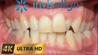 INVISALIGN treatment for 10 MONTHS 4k timelapse [upl. by Adran]