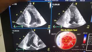 CardioMyopathie Restrictive 58 ansDiagnostic Prise en ChargeSuivie sur 04 ansStrain GE vivid S6 [upl. by Mab]