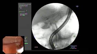 ERCP  Left hilar stricture with stenting [upl. by Notgnillew]