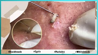 Big Cystic Acne Blackheads Extraction Blackheads amp Milia Whiteheads Removal Pimple Popping [upl. by Floridia]