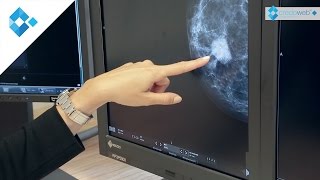 Brustdiagnostik  Knoten frühzeitig erkennen [upl. by Yllod]