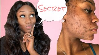 SKIN l Removing Hyperpigmentation Dark Spot Secret  Shanese Danae [upl. by Leann]