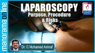 Laparoscopy  Purpose Procedure amp Risks  Dr C Mohamed Ashraf  CRAFT Fertility Centres [upl. by Arihsay]