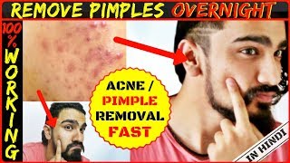 How to Remove Pimples OVERNIGHT for Men in Hindi  Acne amp Pimple Remover  Indian Mens Guide [upl. by Pelmas568]