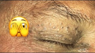 UNBELIEVABLE  LOOK AT THIS EYE HOW FULL OF BLACKHEAD😨 Part1 relaxing blackheads [upl. by Aihsoem]