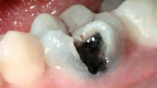 Crowns Large Cavity Diagnosis [upl. by Rosco]