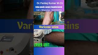 Laser treatment of varicose veins varicose veins surgery shorts varicoseveins [upl. by Eilac]