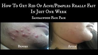 How to get rid of Acne or Pimples in just 1 week Acne Treatment  sandalwood face pack [upl. by Germain]