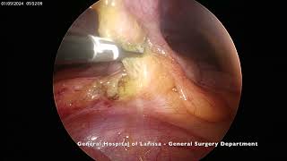 Epiploic Appendagitis [upl. by Holsworth]