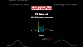 What are Irregular ECG Intervals Telling You🫀🤔 [upl. by Nylehtak]