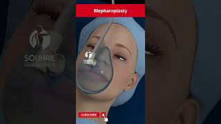 Blepharoplasty procedure [upl. by Hoy]