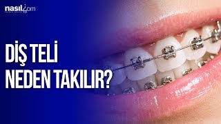 Diş teli neden takılır  Sağlık  Nasilcom [upl. by Hadik961]