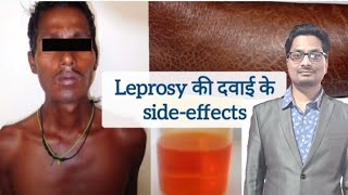 Leprosy की दवाइयों के sideeffects  Dapsone  Clofazimine  Rifampicin  Hansens disease leprosy [upl. by Areic]