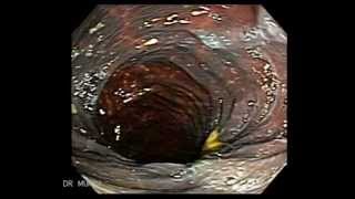 Colonoscopy of Severe Melanosis Coli [upl. by Ahsilif]