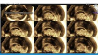 TMT FETAL IMAGING CAVUM SEPTUM PELLUCIDUM [upl. by Zehc]