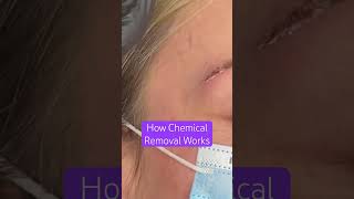 Microblading Removal How Tattoo Removal Works Saline Acid Alkaline [upl. by Nnayrb]