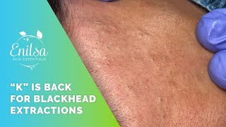 K Is Back for Blackhead Extractions [upl. by Wescott446]