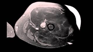 Well differentiated Liposarcoma Left Thigh [upl. by Hulbig525]