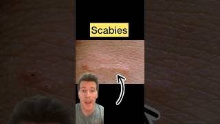 Doctor explains SCABIES in 60 seconds  causes symptoms treatment shorts scabies health [upl. by Asilrahc]