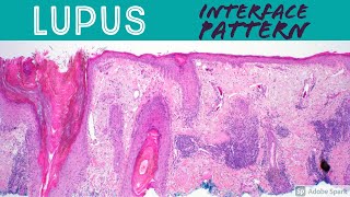 Lupus Erythematosus  Interface Dermatitis Inflammatory Dermpath Basics for Dermatology amp Pathology [upl. by Nybbor96]