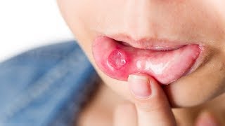 6 Ways How To Cure Mouth Ulcer Permanently In One Day [upl. by Lenahtan]