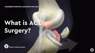 What is ACL Surgery [upl. by Gambrell]