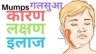 MUMPS  गलसुआ  गलसुआ की दवाई  mumps का इलाज  गलसुआ के लक्षण  क्या हे गलसुआ  Mumps treatment [upl. by Notsirk151]