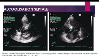 La cardiomyopathie hypertrophique partie 2 [upl. by Yatnohs]