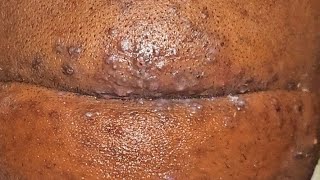 Satisfying Ingrown Hair Removal  Inflamed Infected Whiteheads back of head  Pt 1 [upl. by Washburn]