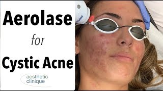 Aerolase for Cystic Acne [upl. by Zoubek]