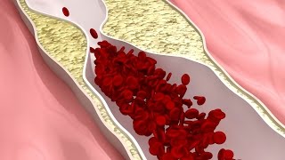 ¿Cómo y por qué ocurren los derrames cerebrales [upl. by Akener659]