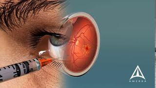 How Macular Degeneration Affects Your Vision  3D animation [upl. by Zachariah]