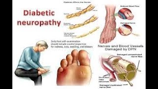 Diabetes Neuropathy Symptoms Causes and Management [upl. by Consolata]