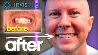 Is Invisalign WORTH It Honest Review  Before and After Pics [upl. by Ggerg]