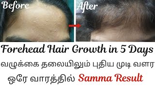 Forehead hair growth in 5 daysNew hair grow in forehead on 5 daysForehead hair growth naturally [upl. by Blunk]