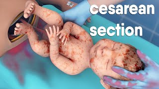 A cesarean section  known as a Csection  is a surgery to deliver a baby via the abdomen [upl. by Umeh]