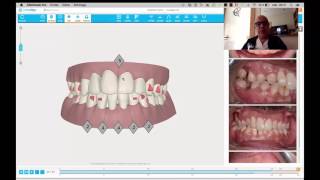 Invisalign clean check pro [upl. by Colston58]
