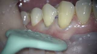 treatment of cervical dental caries  placement of a composite filling on the tooth dentist teeth [upl. by Esch961]