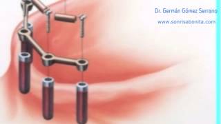 implantes dentales explicacion facil de entender  vídeo para pacientes [upl. by Esme545]