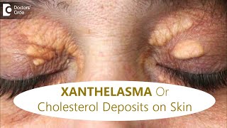 FATTY DEPOSITS of CHOLESTEROL around EYES  How to get rid of itDrRajdeep MysoreDoctors Circle [upl. by Carrol]