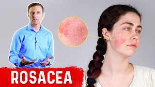 What Can Be Done for Rosacea [upl. by Laveen466]