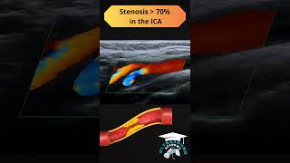 Severe Carotid Artery Stenosis Ultrasound Findings Explained ultrasound ultrasoundcases [upl. by Danila5]