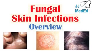 Overview of Fungal Skin Infections  Tinea Infections [upl. by Clarise]