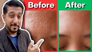 How to Rid Fungal Acne  Fungal Acne Treatment THAT WORKS for Malassezia Folliculitis [upl. by Noerb]