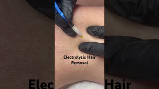 Electrolysis Hair Removal [upl. by Eronaele949]