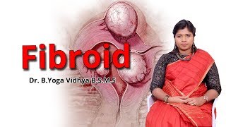 ஃபைப்ராய்டு கட்டிகளுக்கு சிகிச்சை  Fibroid Uterus Treatment  Dr BYoga Vidhya [upl. by Jerrine]