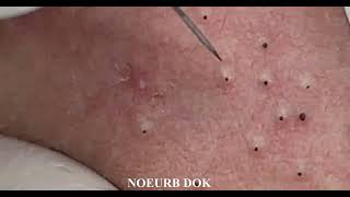 Popping Tons Of Blackheads Part 01 [upl. by Natsud]