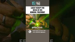 Laser Therapy for Nevus of OTA Removal Treatment  Nevus of OTA Treatment in Delhi  Dr PK Talwar [upl. by Garber]