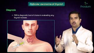 Thyroid neoplasms part 2  Follicular carcinoma of thyroid   Endocrine pathology [upl. by Prinz]